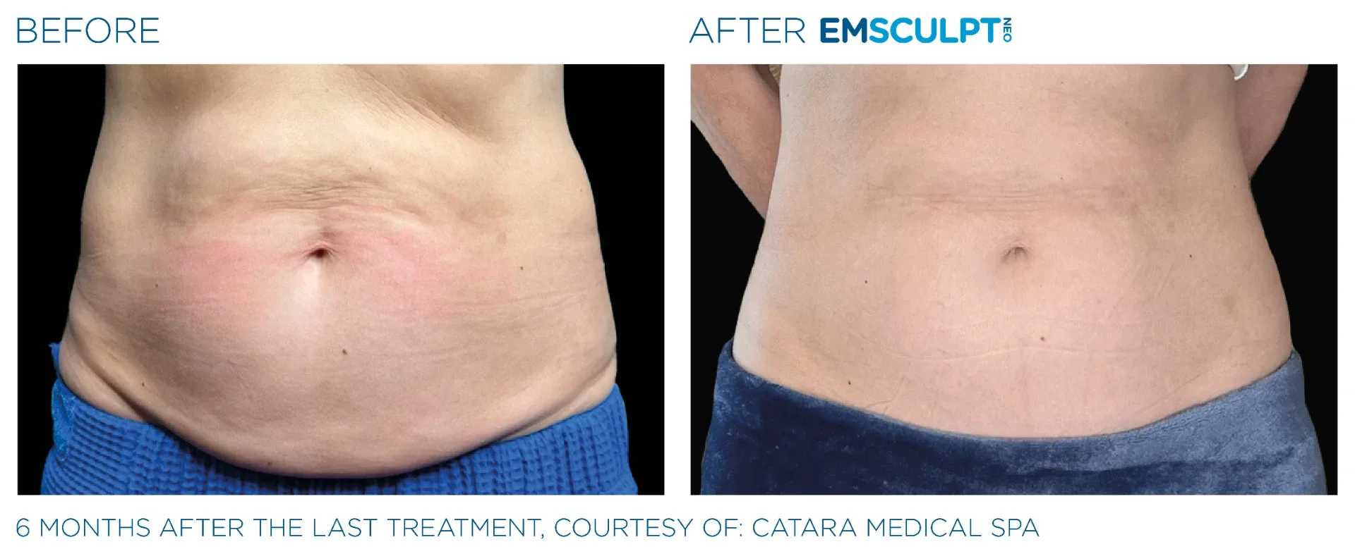 Before and after Emsculpt NEO on an abdomen, six months after the final treatment