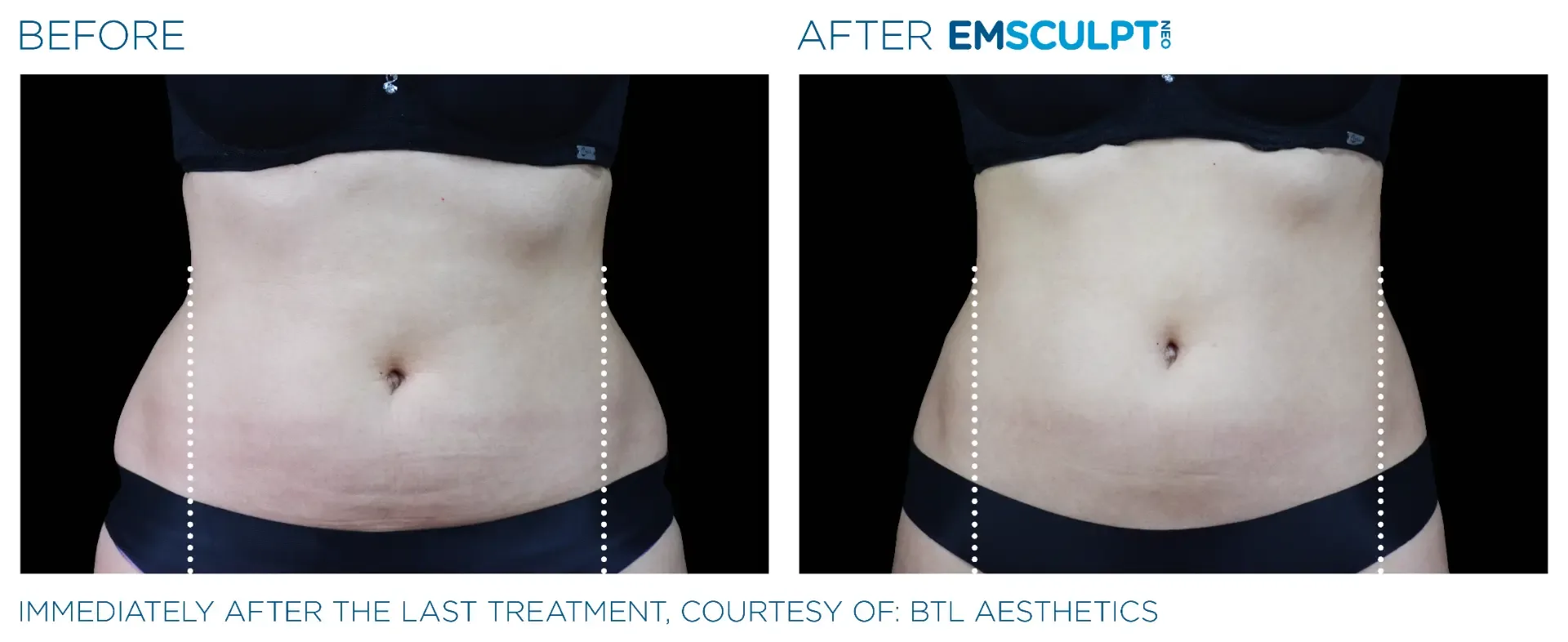 Before and after Emsculpt NEO on a woman's abdomen, front view, immediately after the final treatment