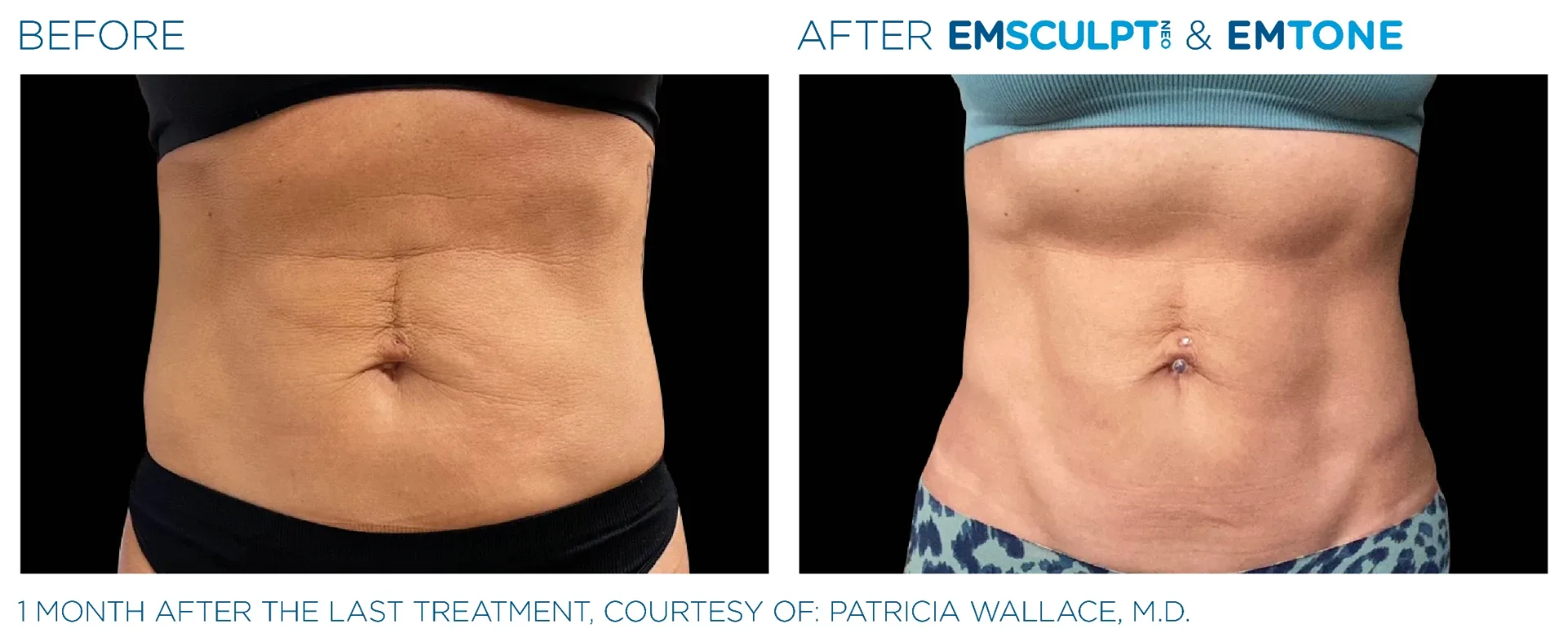 Before and after Emsculpt NEO combined with Emtone on an abdomen, one month after the final treatment; the change reflects both