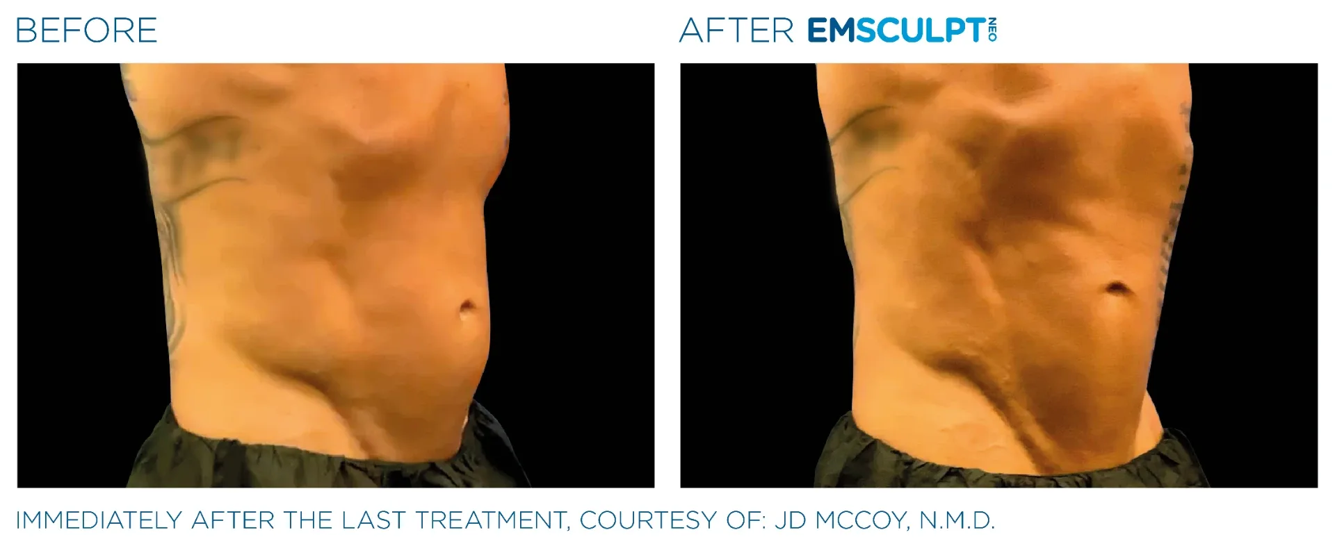 Before and after Emsculpt NEO on the abdomen and obliques, immediately after the final treatment