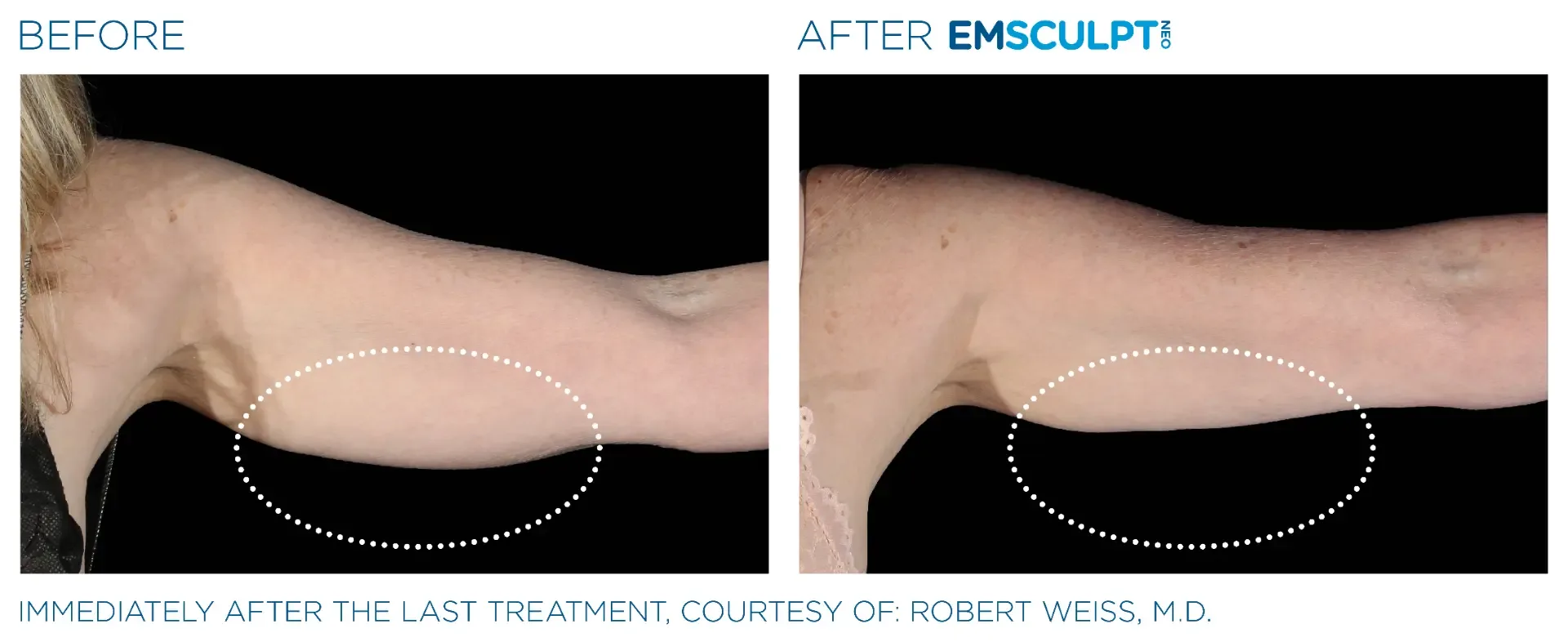 Before and after Emsculpt NEO on an upper arm, side view, immediately after the final treatment