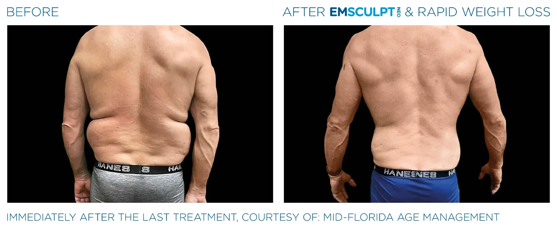 Before and after Emsculpt NEO combined with rapid weight loss on the flanks and back, immediately after the final treatment; the change reflects both
