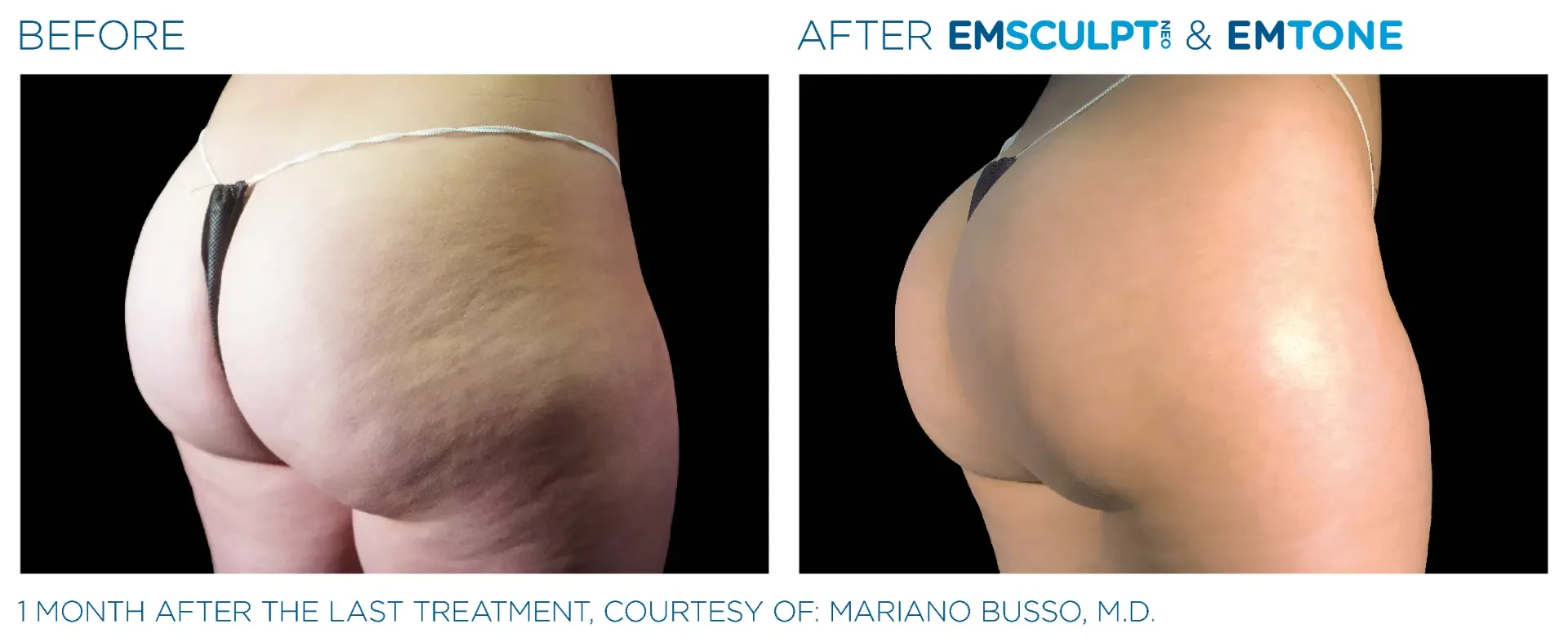 Before and after Emsculpt NEO combined with Emtone on the buttocks, side view, one month after the final treatment; the change reflects both