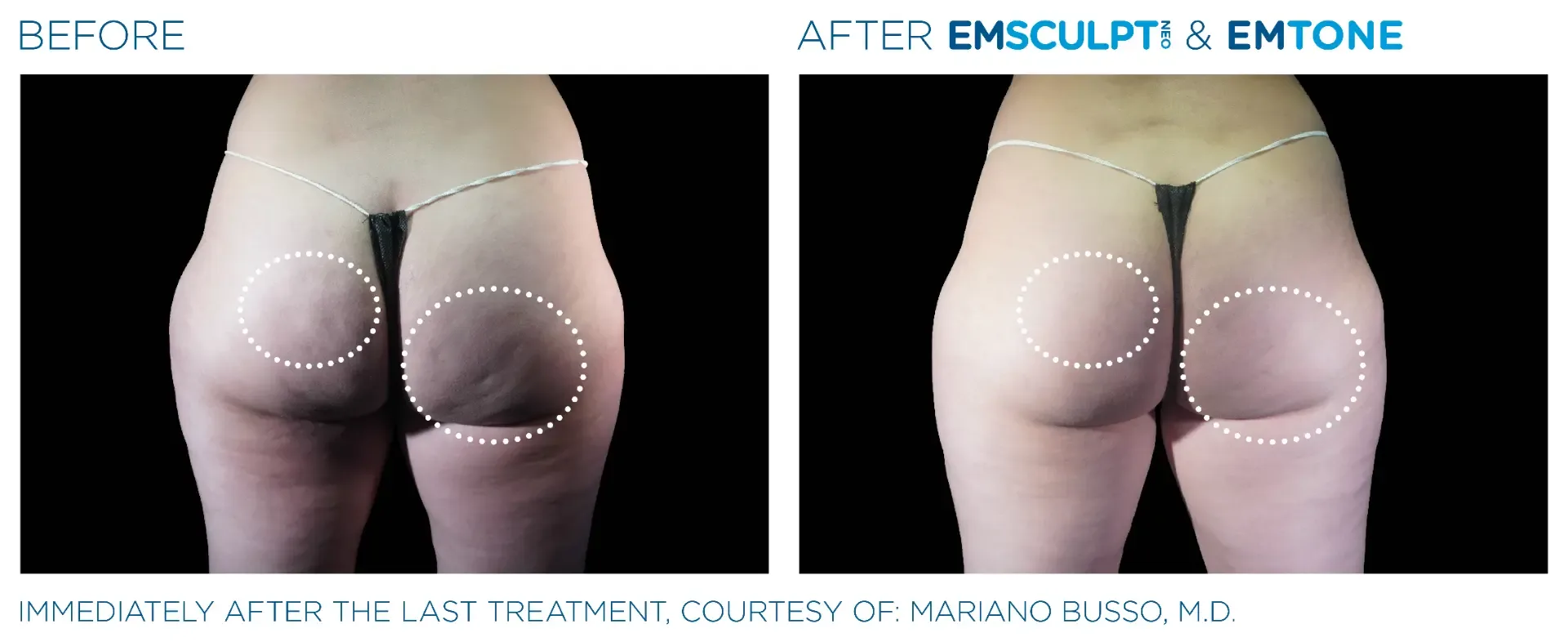 Before and after Emsculpt NEO combined with Emtone on the buttocks, immediately after the final treatment; the change reflects both